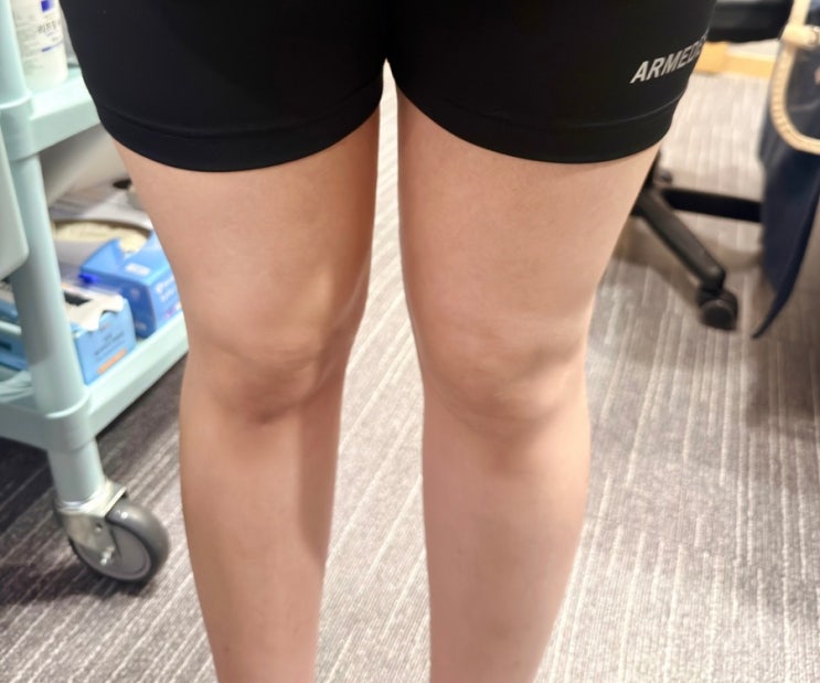  신사역 다이어트｜허벅지 바디온다와 TC핏 주사 받아본 내돈내산 후기