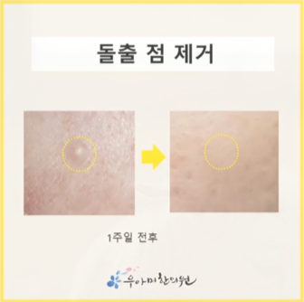 여자 콘딜로마, 쥐젖으로 생각하고 지나치는 경우가 많습니다