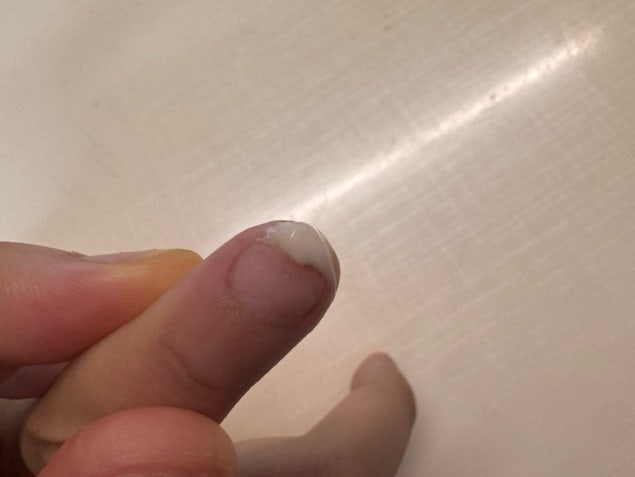 어린이 손끝사마귀 율무 자가치료 사마킬 솔직후기