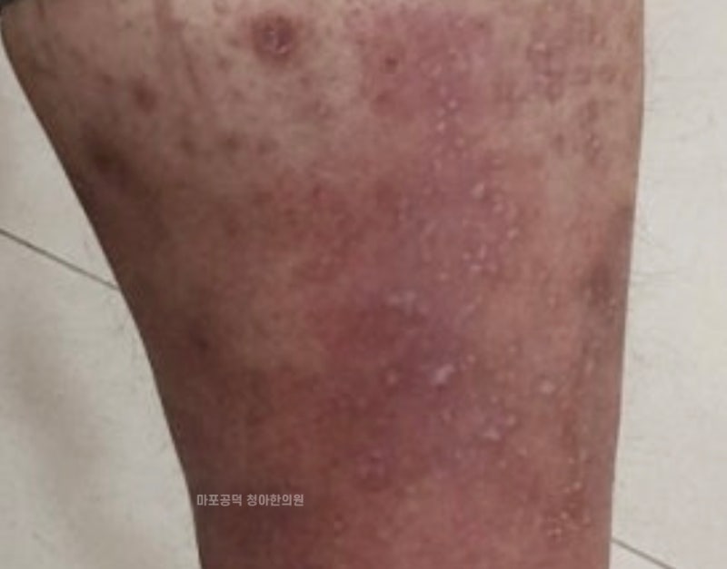 사타구니 습진 병원 어디로 가야 할까? 치료받아도 계속 재발한다면, 3가지 체크리스트
