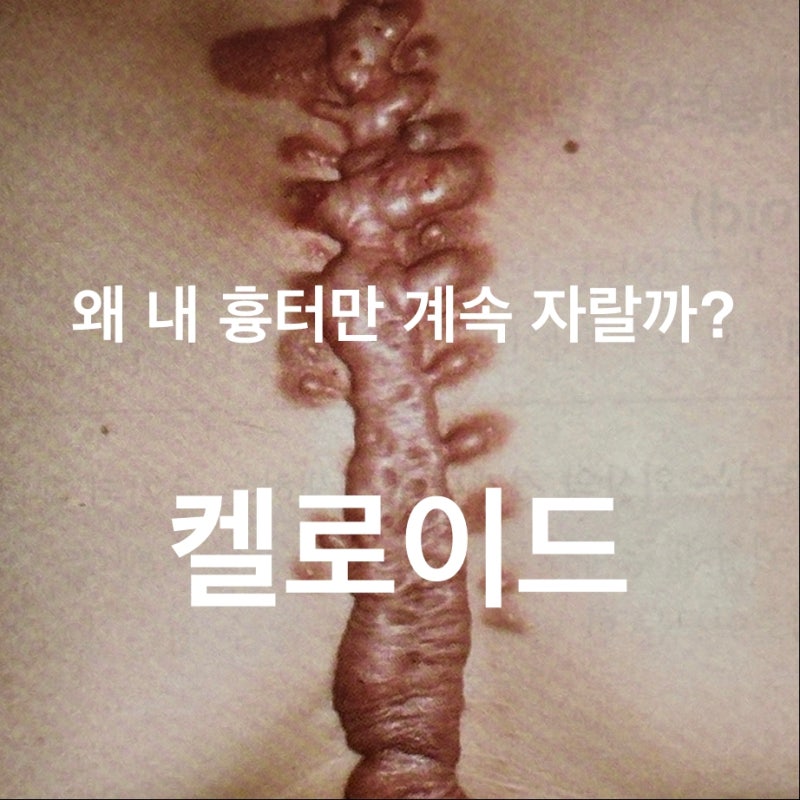 대구 켈로이드 흉터 치료 피부과 장재원피부과 의원
