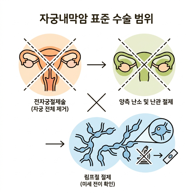자궁내막암 치료 방법 총정리 / 수술·방사선·항암 치료 선택 기준