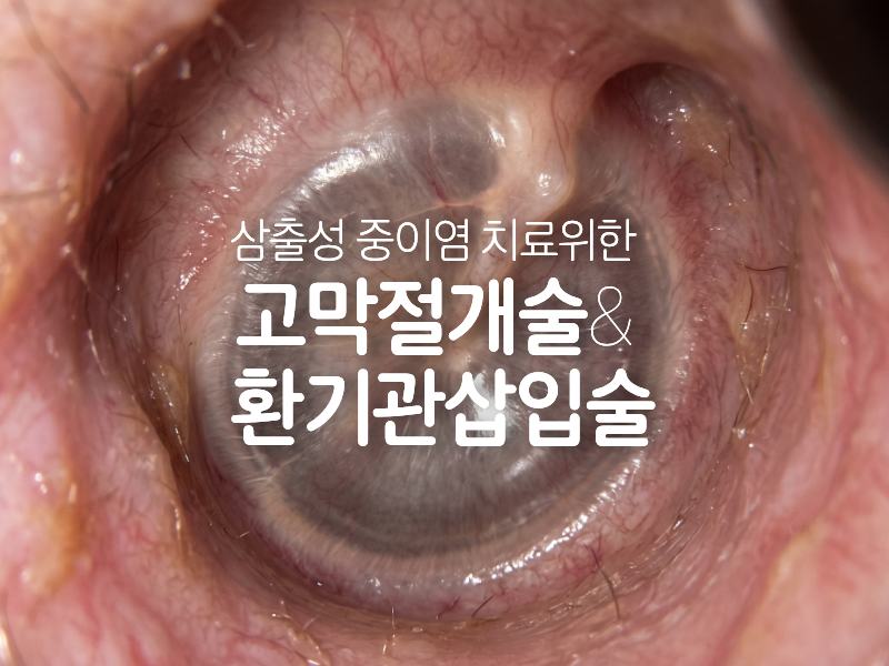 삼출성 중이염 치료 위한 고막절개술 & 환기관삽입술