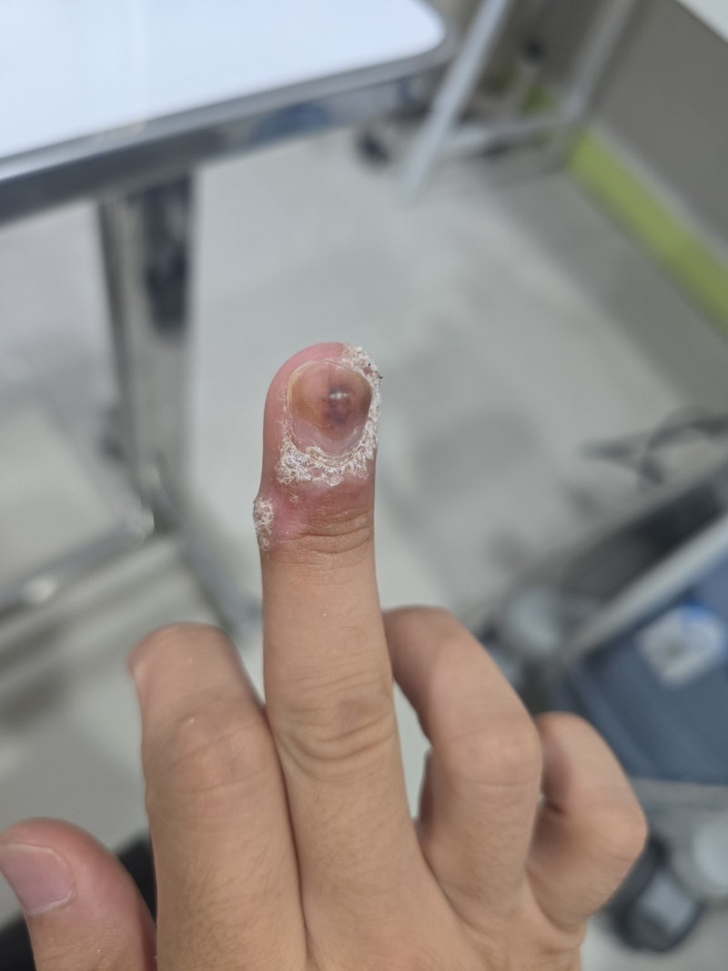 손가락 사마귀 완치과정(걍 잡아뜯자) - 치료되기까지 시간과 베루말과 엔드와츠 사용한 용....