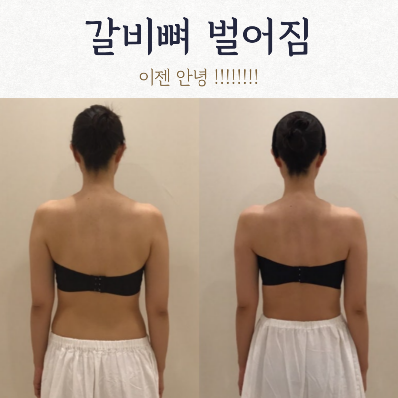 갈비뼈벌어짐 고민, 흉통줄이기 비법으로 다시 태어나기