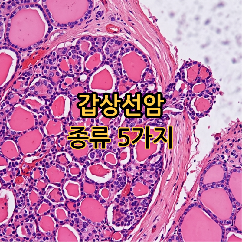 갑상선암 종류 5가지