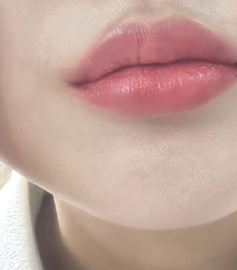 청주입술필러추천 성안길 피부과 1~4일차 후기