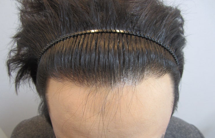 대전탈모성지 <b>모발이식</b> 치료 후기 차이가 뭘까?