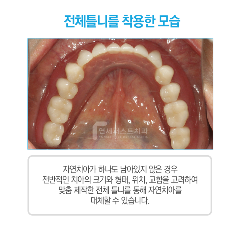 부천틀니 치과, 부분틀니 고민 전 확인해야 할 부분