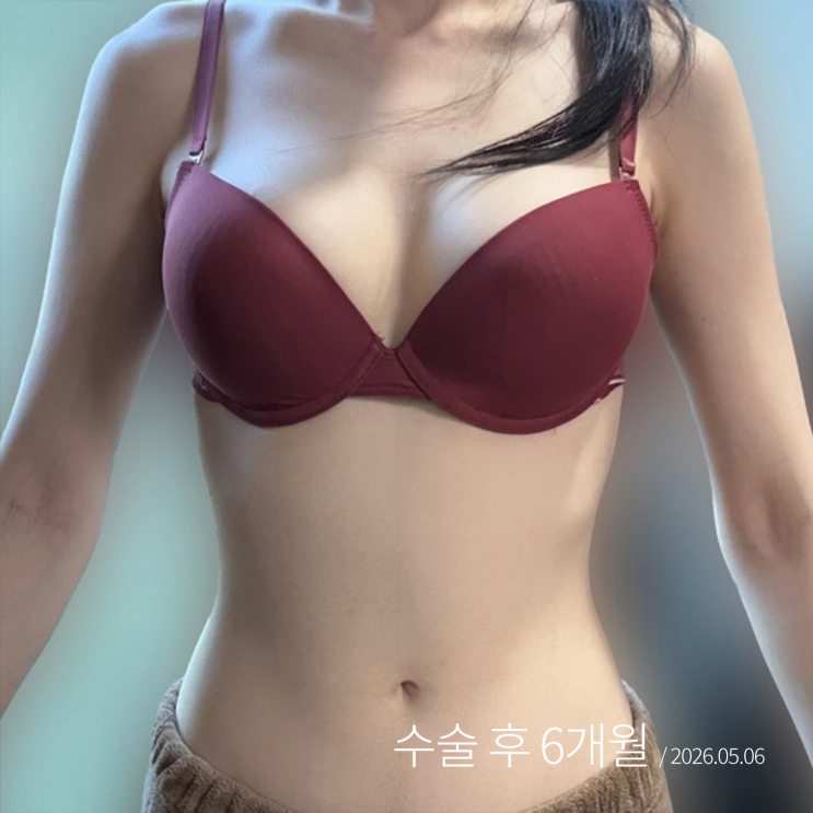  복부지방흡입후기 | 붓기 빠지고 나서야 보이는 6개월 결과