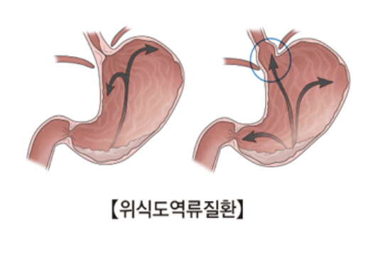 위식도역류병