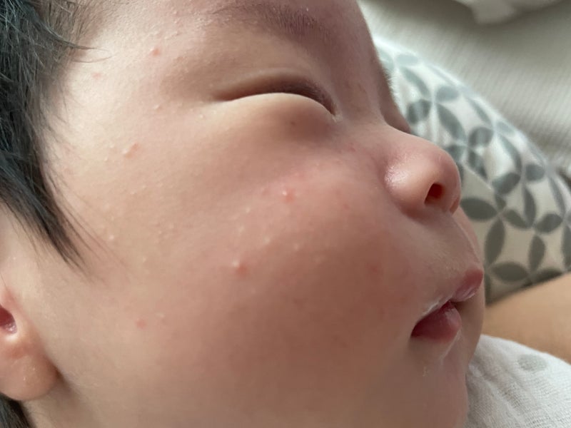 신생아 태열관리, 비판텐·수딩젤 발라도 될까요? 아기 얼굴 좁쌀 여드름 나오면 이렇게!