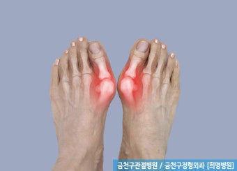 무지외반증 신발-닿으면아픈데 뭘살까