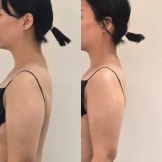 #신논현역피부관리 캐롤뷰티｜테라노바 데콜테관리 1회만에 턱선·허리라인 변화 느낀 신논....