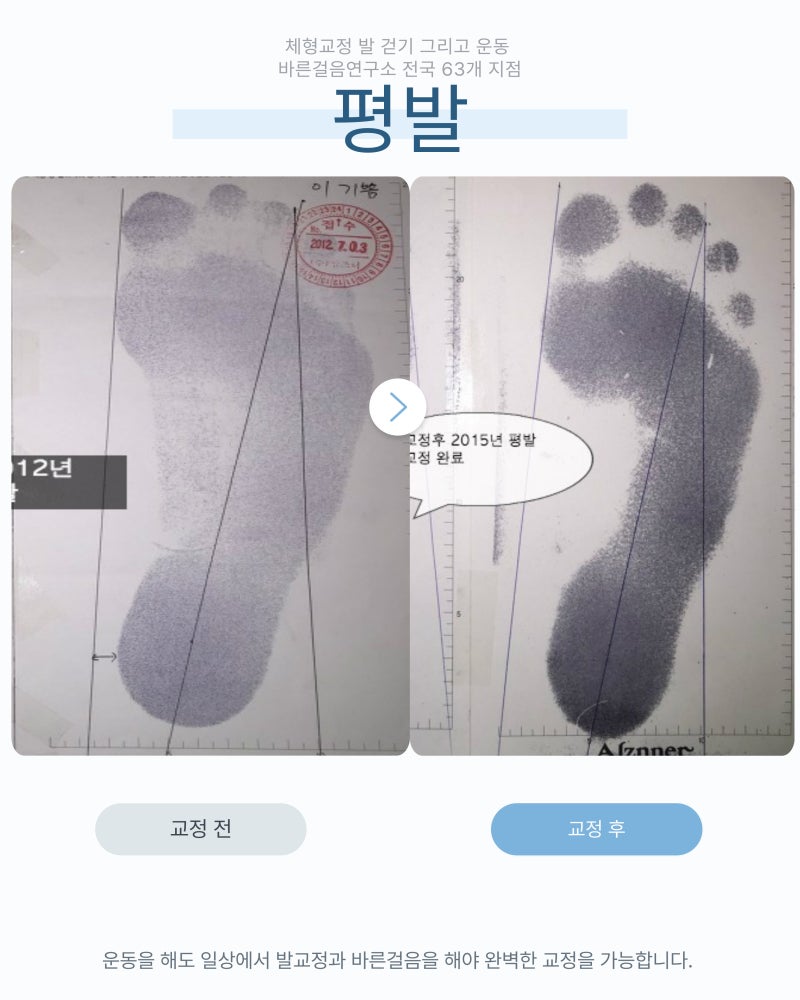 유아 청소년 척추측만증, 부모가 알아야 할 10가지