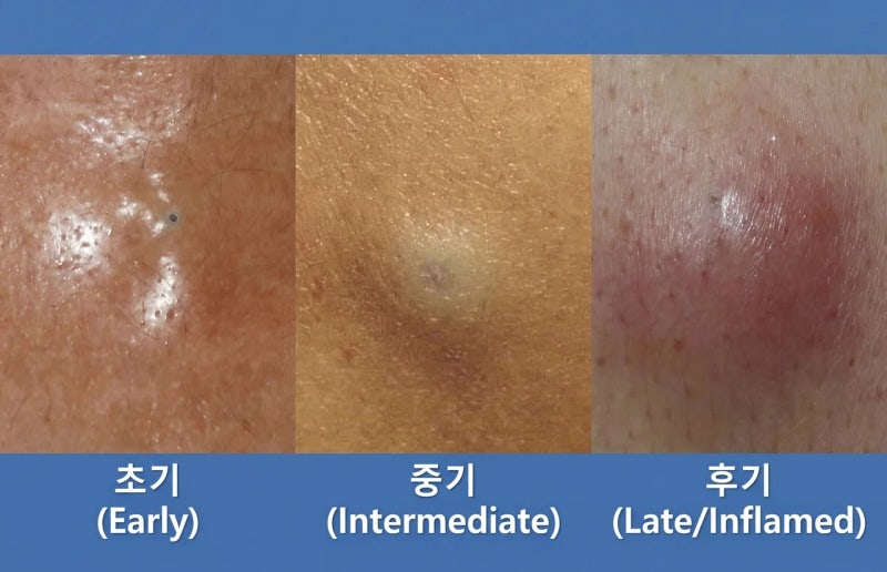 [봉담 성모피부과] 짜도 짜도 자꾸 생기는 피부 혹, '표피낭종' & '피지낭종' 원인부터 흉터 없....