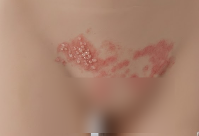 헤르페스 2형 영양제 진짜 효과 있을까? 3년 먹어본 솔직 후기