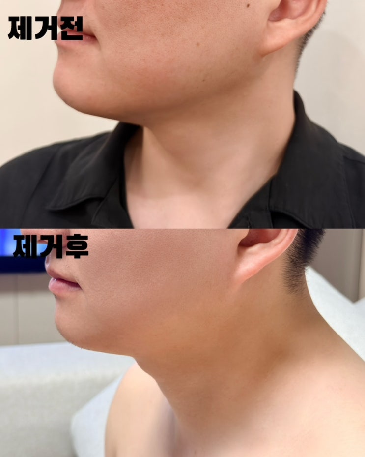  시흥부평 편평사마귀 쥐젖 제거 무제한 후기 2편｜딱지 떨어진 후 변화