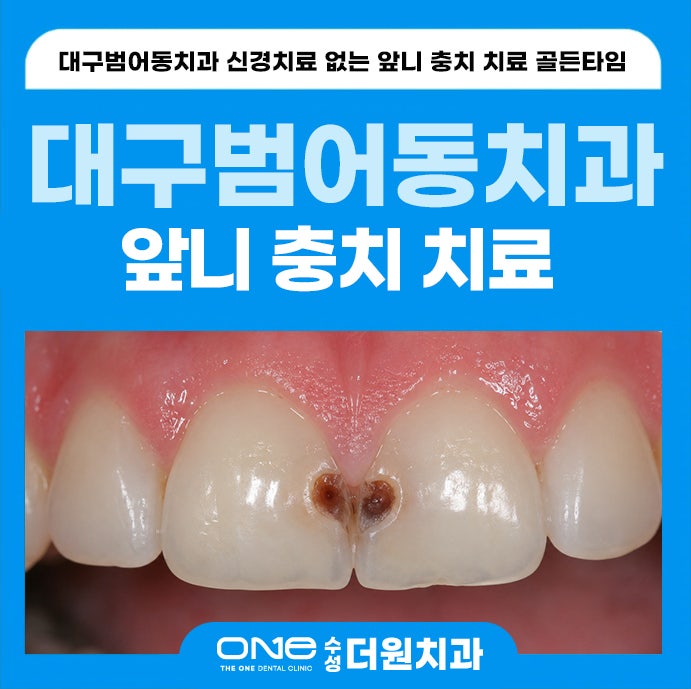 대구범어동치과 신경치료 없는 앞니 충치 치료 골든타임