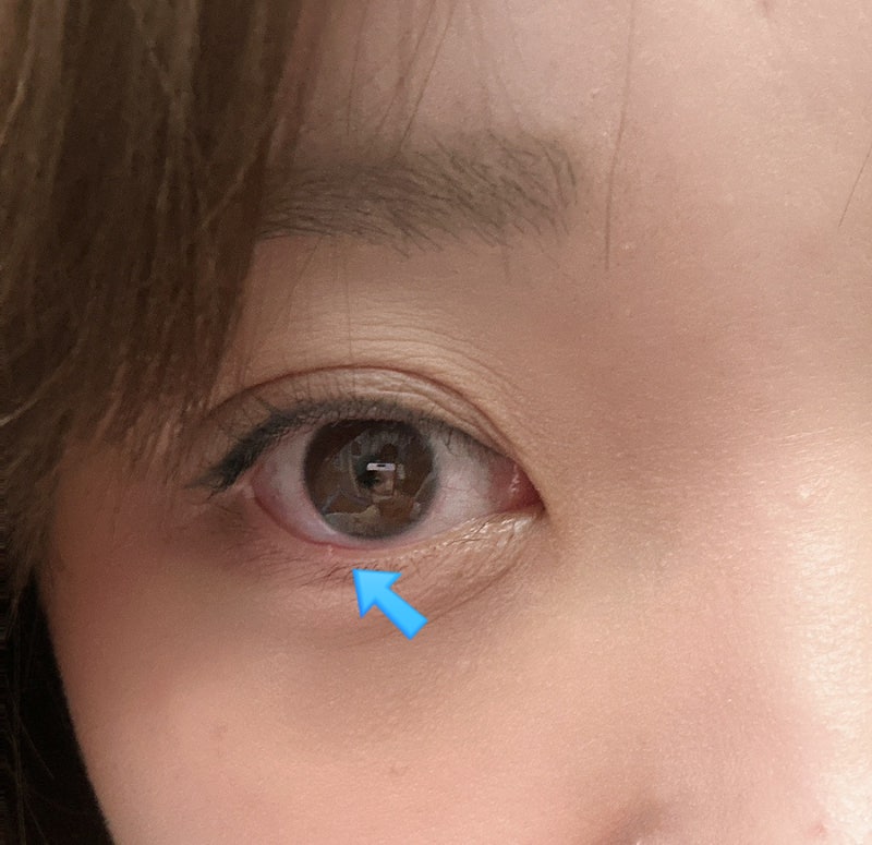 눈 밑 다래끼 생겼을 때, 약국 안약과 먹는 약 효과는?