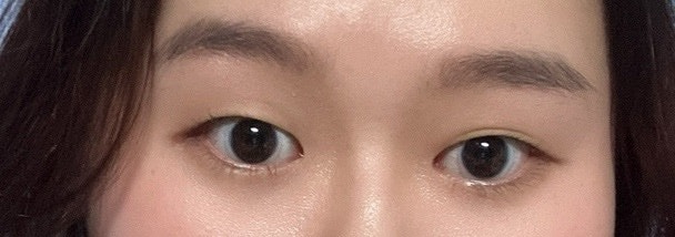 성인안검내반 수술 후기2 비용 실비, 첩모난생 (연세대학교 세브란스병원)