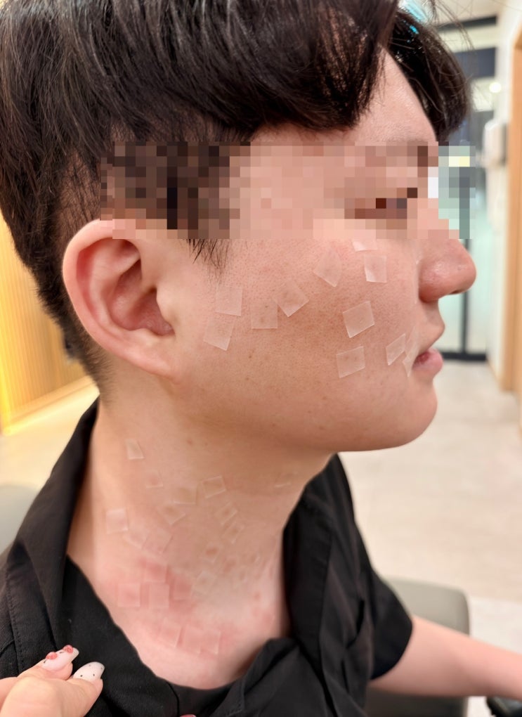  시흥부평 편평사마귀 쥐젖 제거 무제한 후기 1편｜몇 년을 미루던 남편 드디어 제거하러 가다