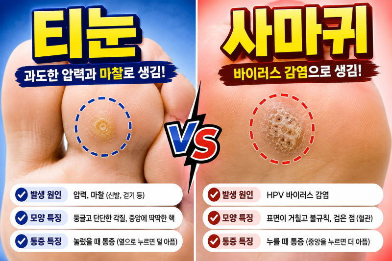 티눈 제거도 수술비 보험금 받을 수 있을까?