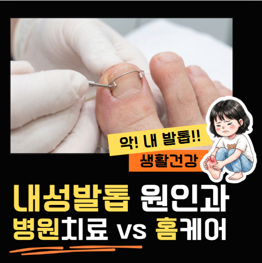 [지옥 같은 통증] 내성발톱 자가치료법과 2026 최신 교정 비용 총정리! (진작 알았더라면...)