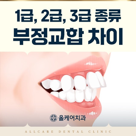 부정교합 1급, 2급, 3급 종류 차이 — 내 턱은 어느 유형일까요?