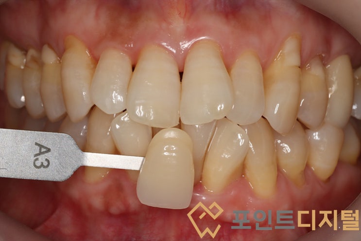  [천안 치아미백] 50대 환자분의 1년 롱텀 미백 리얼 후기! 치경부 레진과 미백의 시너지 효과 (feat. 터치업 미백)