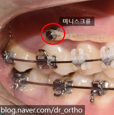  교정용 나사가 빠졌어요 - 미니스크류 탈락 어떻게 해야 하나요?