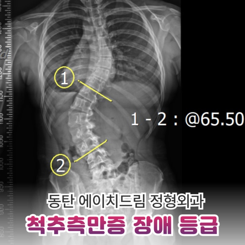 척추측만증 장애 등급 기준 40도, 거기까지 가는 아이들의 공통점 3가지
