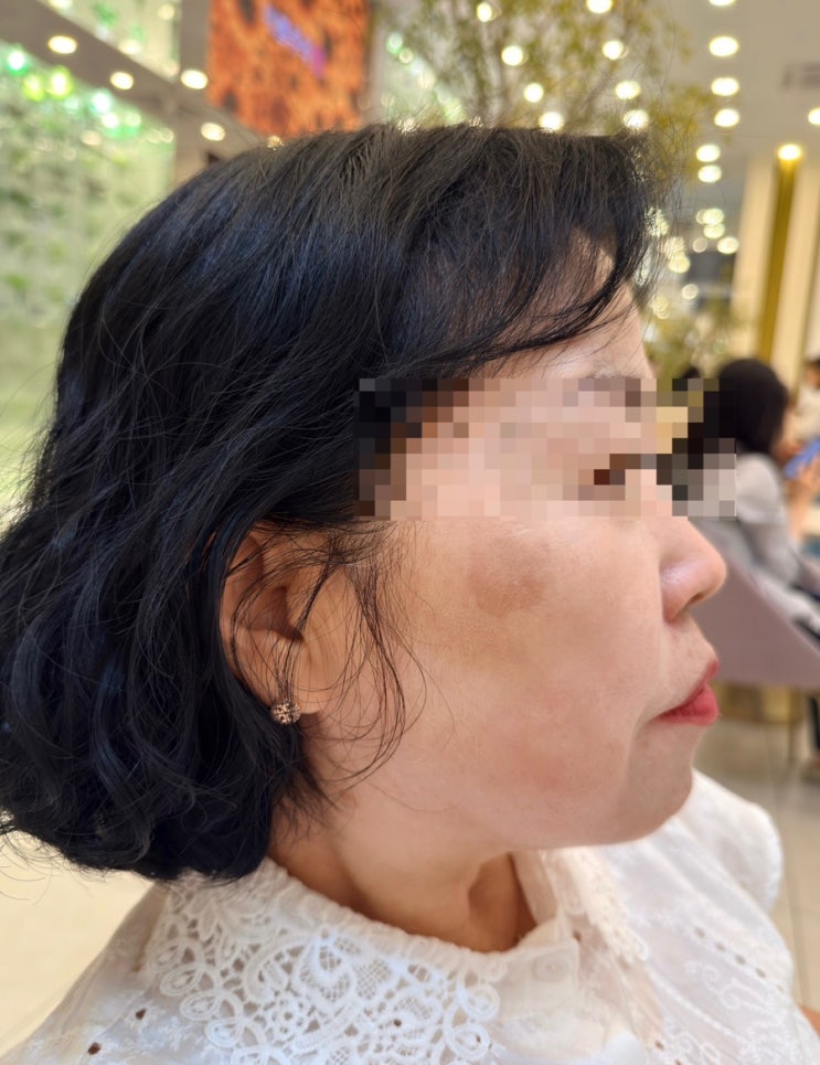  신논현피부과 흑자레이저 후기｜예쁨주의쁨의원 강남본점에서 엄마 효도관리