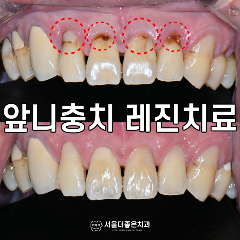 앞니 충치와 변색으로 인한 레진치료, 치료비용과 수명에 대해 (경기광주 신현동 치과 앞니....
