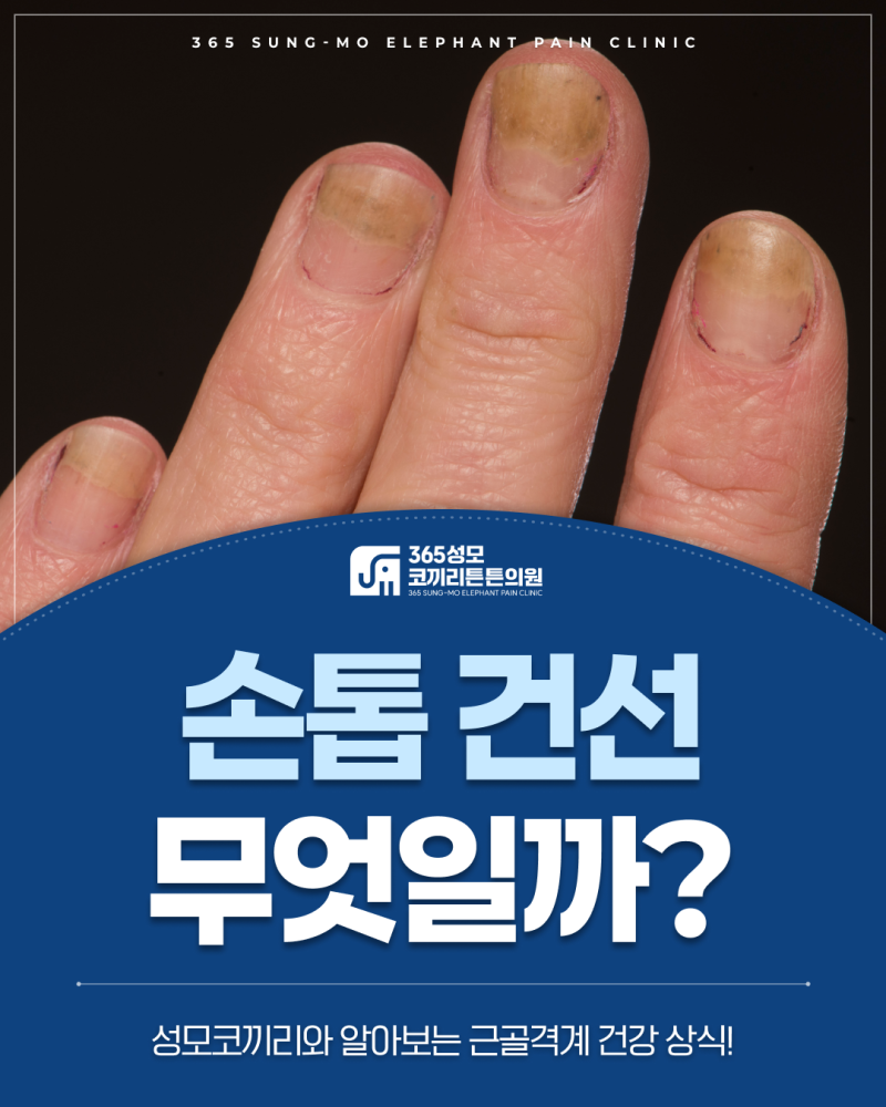의왕정형외과 울퉁불퉁한 손톱? 손톱 건선을 의심해보세요