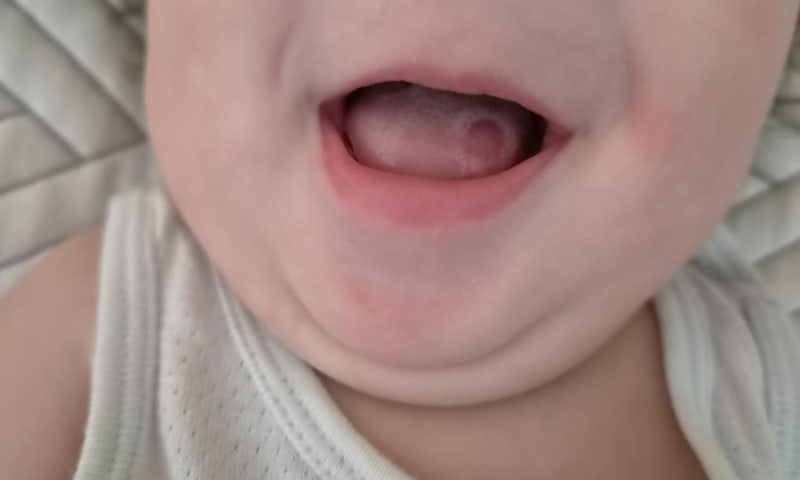 4개월 아기 혀에 딸기점 혀 지도설