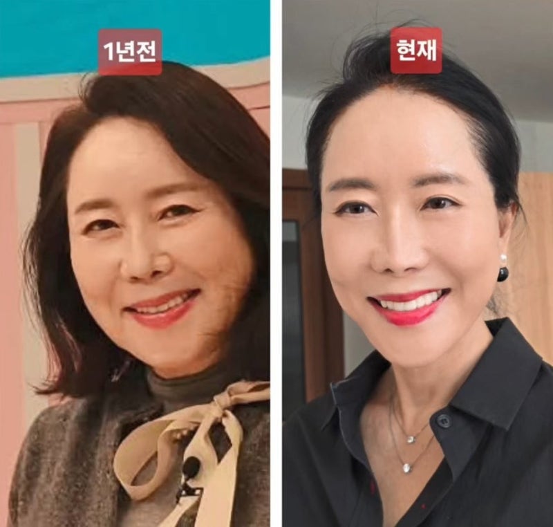 윤영미 안면거상 시술 고백, 병원 어디냐고 난리난 이유