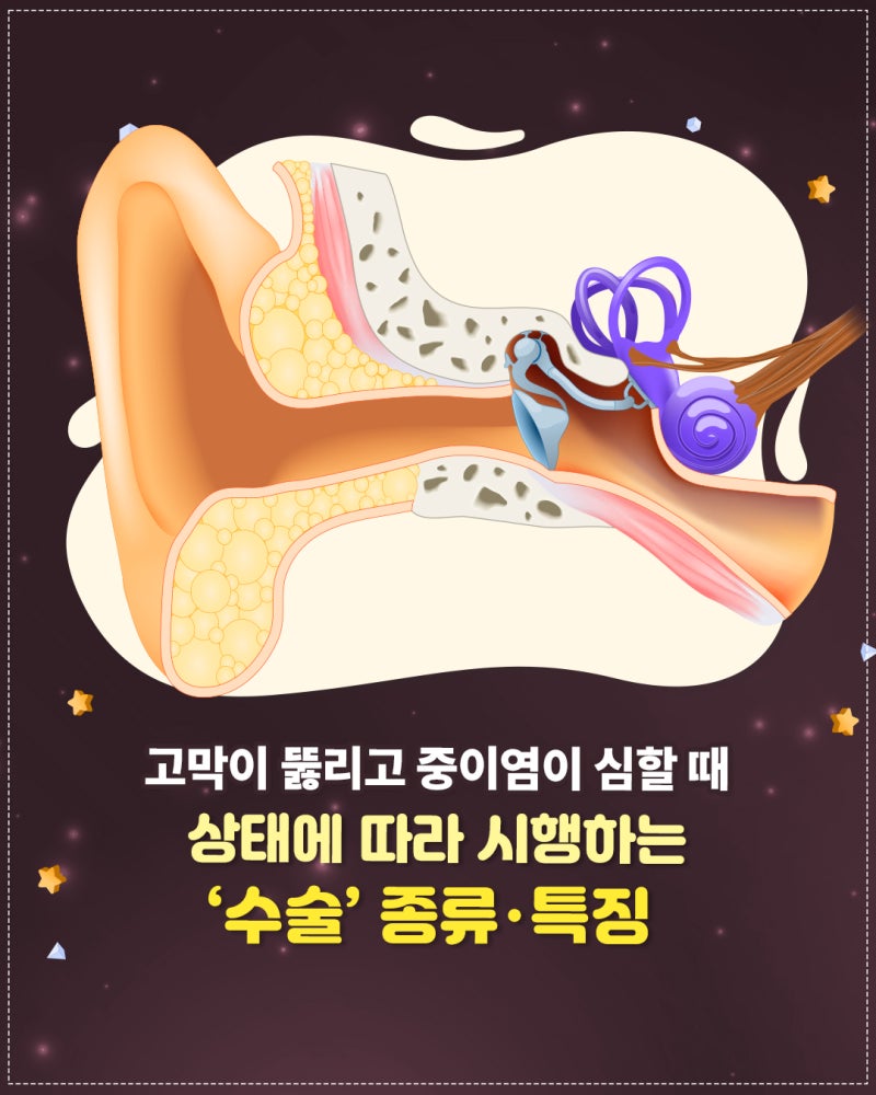 고막이 뚫리고 중이염이 심할 때 상태에 따라 시행하는 ‘수술’ 종류‧특징