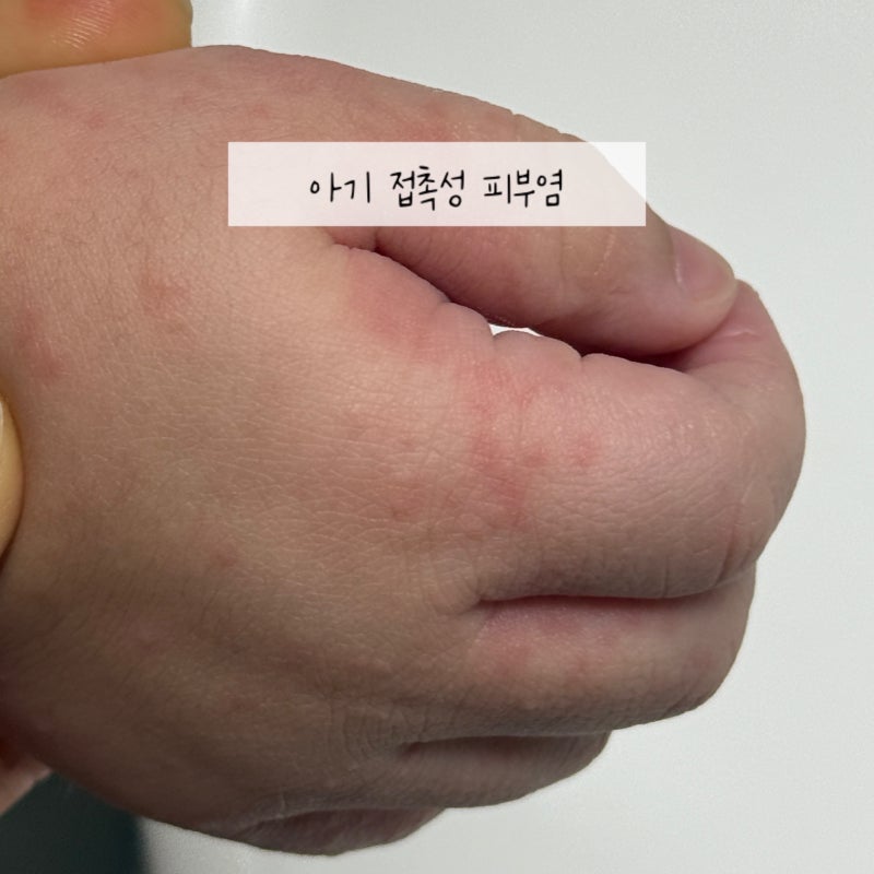 아기 오돌토돌 피부 아기 접촉성 피부염 원인 및 관리방법
