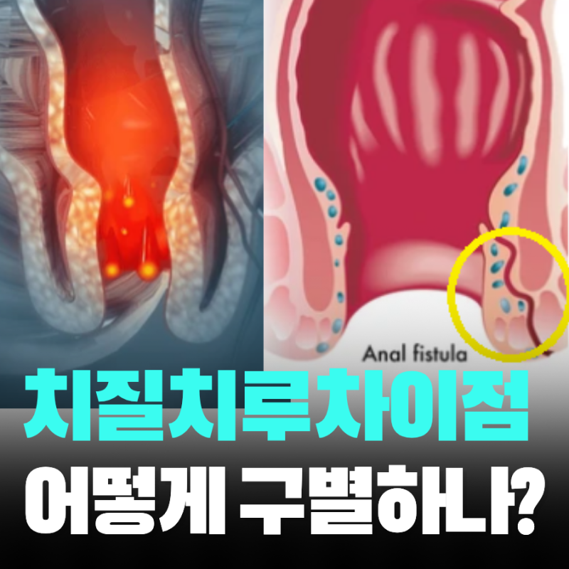 치질 치루 차이 증상 구별하는 방법