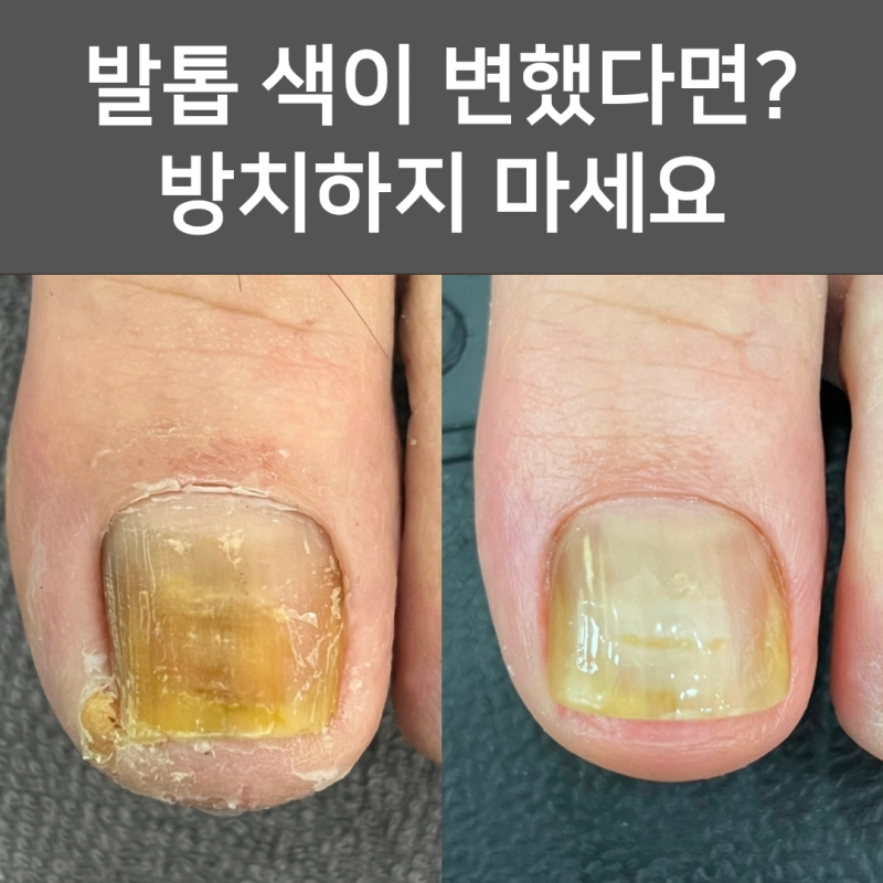 광주 무좀발톱 병원 고민 끝! 수완지구에서 관리받아본 후기