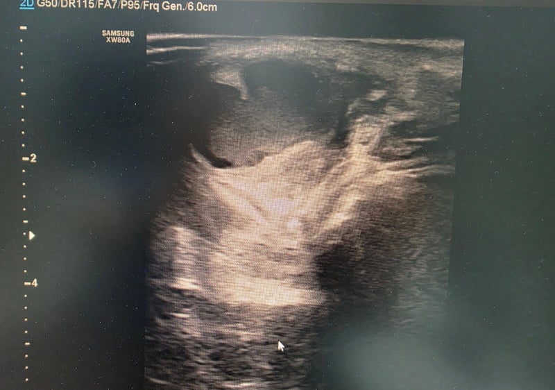 바르톨린낭종 재발, Marsupialization 후 또 생겼다면? Bartholin Gland Excision이 필요한 이유