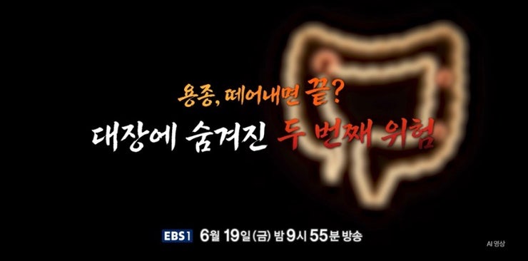 ssl 대장용종 <b>소화기내과 김진수</b> 대장항문외과 김형진 <b>교수</b>