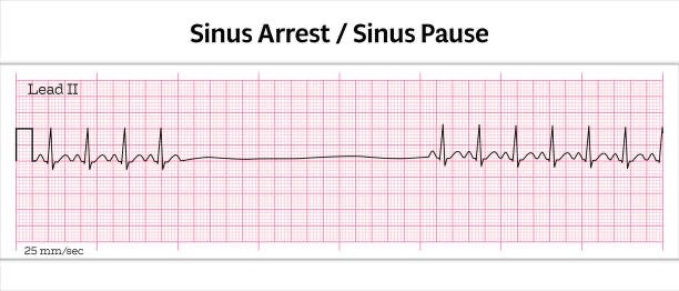 [cardio] EKG Pause 원인부터 Pause 몇 초인지 재는 법 + 임상적 의미