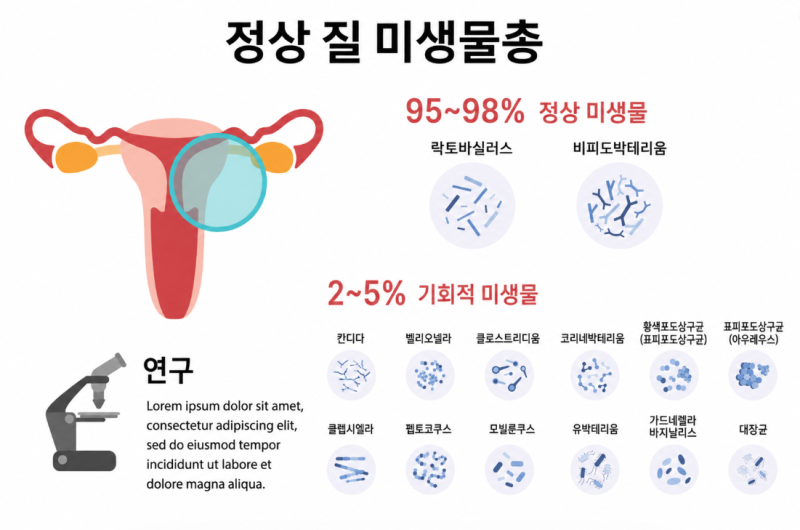 무증상 여성 질검사의 오해와 진실.... 마이코플라즈마 호미니스 · 유레아....