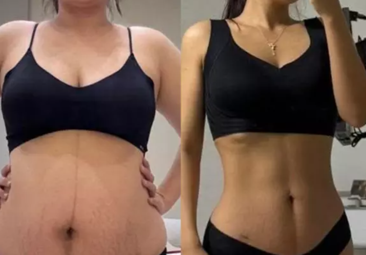 살은 빠졌는데 배는 더 나와 보이고 소화불량 ? 다이어트 후 위하수 의심되는 이유 : 위하수....