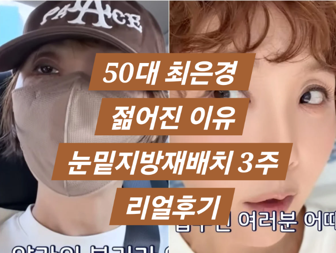 최은경 눈밑지방재배치 3주 리얼후기! 젊어진 이유