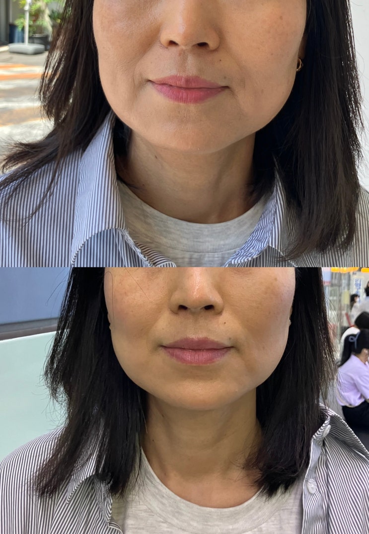  대구피부과 리프팅잘하는곳 슈링크 400샷 후기, 전후비교