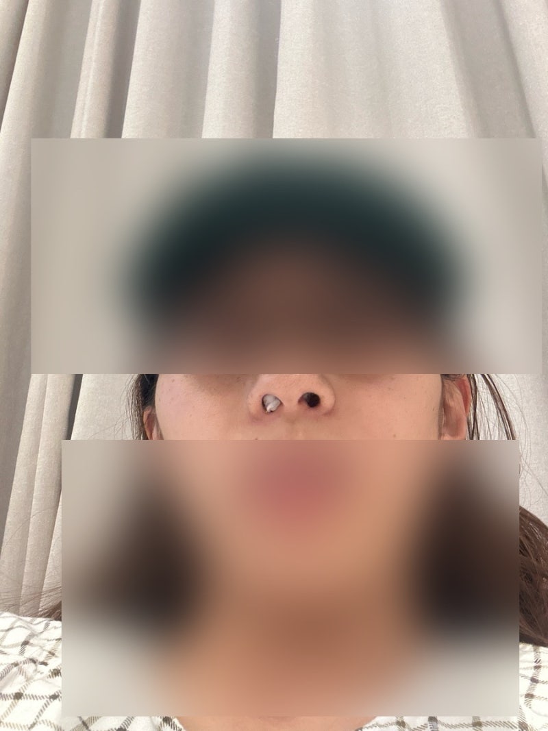 비염 축농증 당일 수술 퇴원 후기(+수술 후 일주일 후기)
