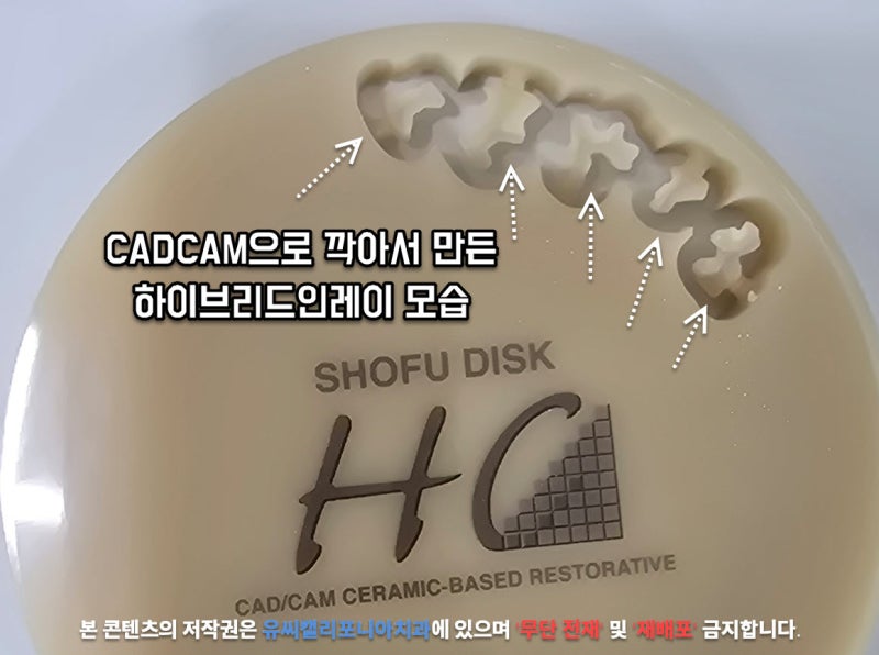 레진 인레이 업글버전 하이브리드 가격 차이 얼마나?